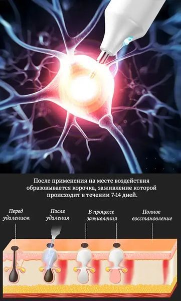 Коагулятор плазмовий, plasma pen/електрокоагулятор/бездротова ручка для видалення папілом та бородавок 00015691 фото