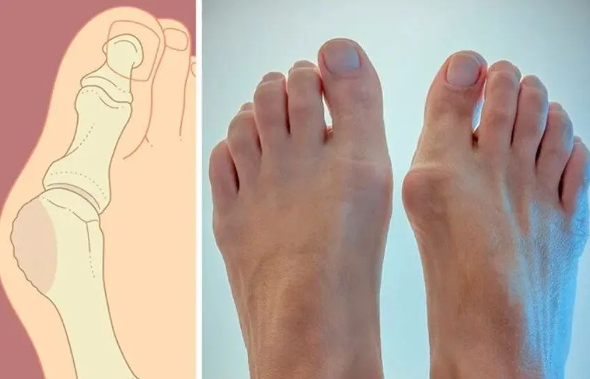 Магнитная вальгусная шина relax foot (magnet fix) магнитный корректор стопы 00015555 фото