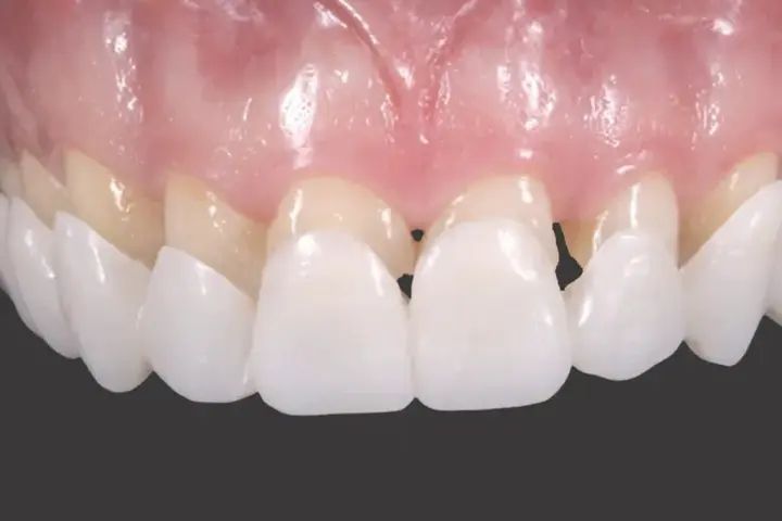 Виниры для зубов верх Snap On Smile 00015046 фото